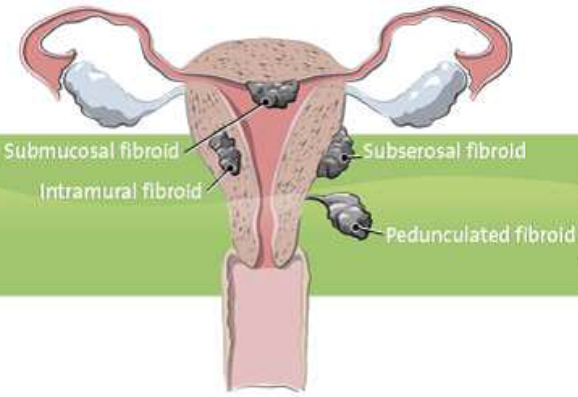 Uterine Fibroid Embolisation Or Uterine Artery Embolisation Uae Patient Information 4857