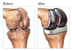 Total Knee Replacement Patient Information Brochures Mater Group