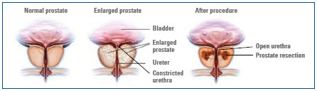 TURP Transurethal Resection of the Prostate