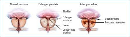 Trans Urethral Resection Of The Prostate Turp Patient Information Brochures Mater Group