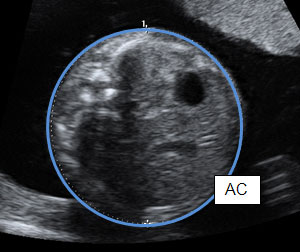 Pregnancy Sonography Chart