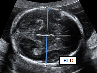 Pregnancy Sonography Chart