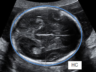 Ultrasound Scan Fetal Growth Scan Patient Information Brochures Mater Group