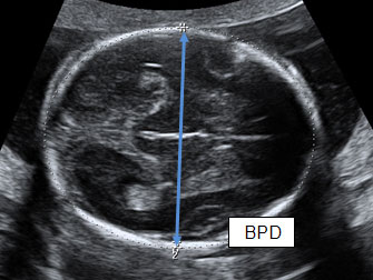 Ultrasound to determine gestational age