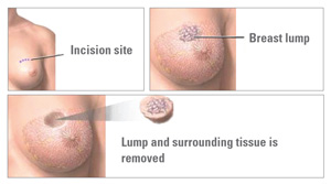 Images of wide excision