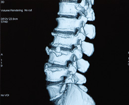 Spinal care following surgery - Patient Information Brochures