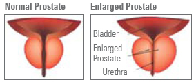 prostate