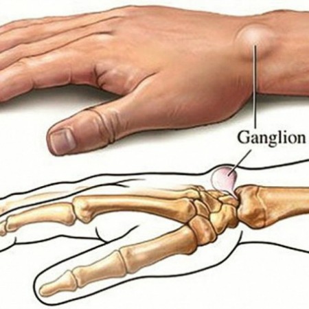 ganglion cyst diagram