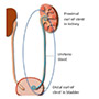 Ureteric Stent - Patient Information Brochures - Mater Group