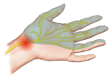 Article: What Does Carpal Tunnel Syndrome Feel Like?