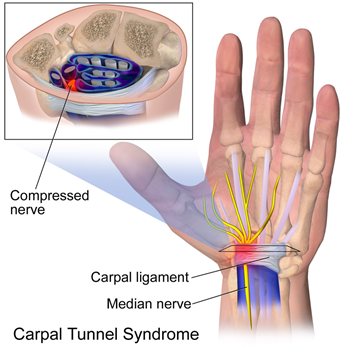 Carpal-Tunnel-Syndrome.png