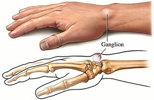Ganglion.jpg Ganglion.jpg