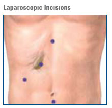 laparoscopic incision