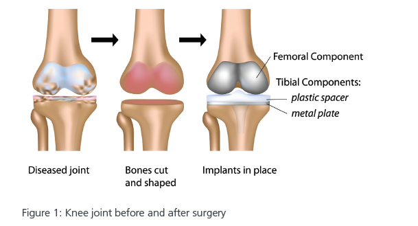 total-knee-replacement.PNG
