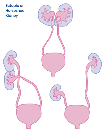 ectopic-kidney.png
