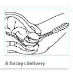Forceps-delivery.JPG