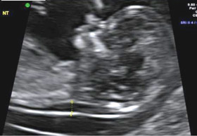 An ultrasound scan image