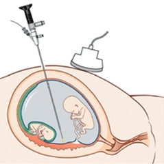 Fetal laser surgery