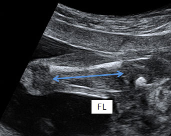 32 weeks pregnancy ultrasound vs 2 weeks old 🤍