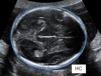 30 weeks pregnant ultrasound