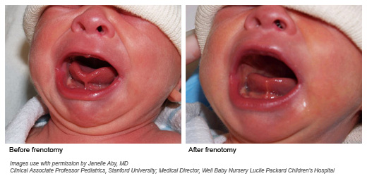 before and after frenotomy